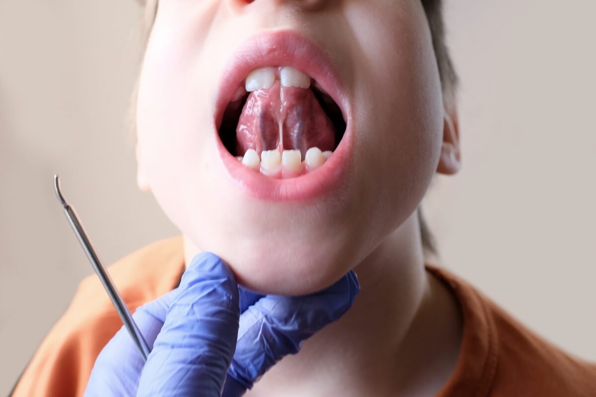 Doctor-Examining-Frenectomy Doctor Examining Frenectomy
