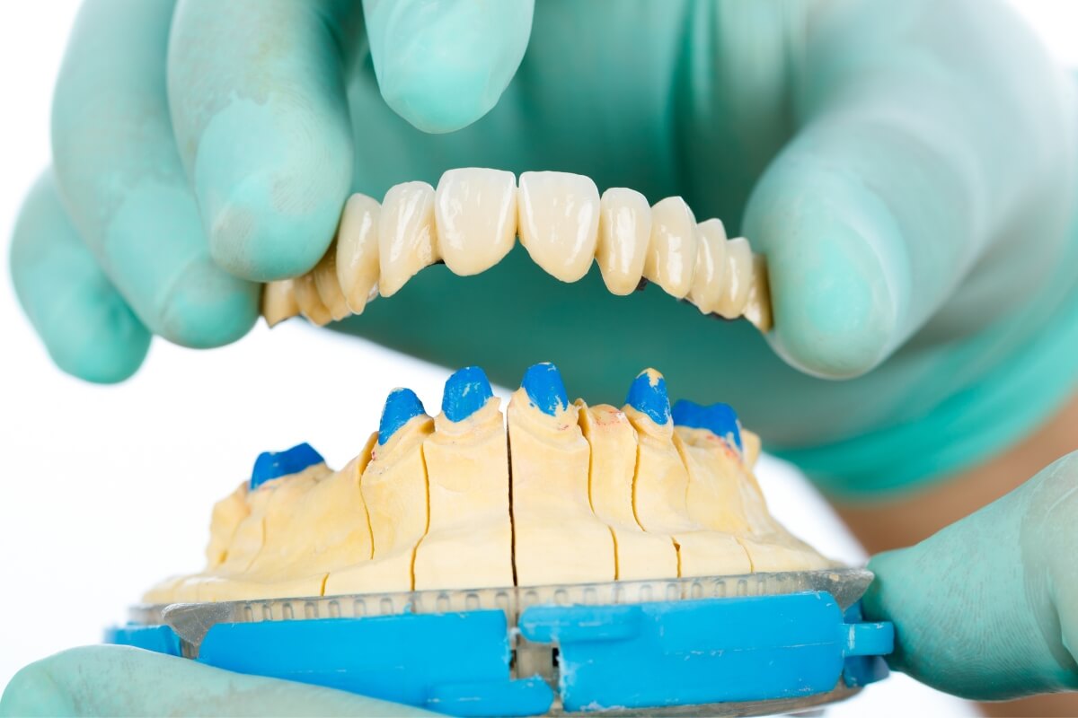 Porcelain-Teeth-Dental-Bridge Porcelain Teeth Dental Bridge