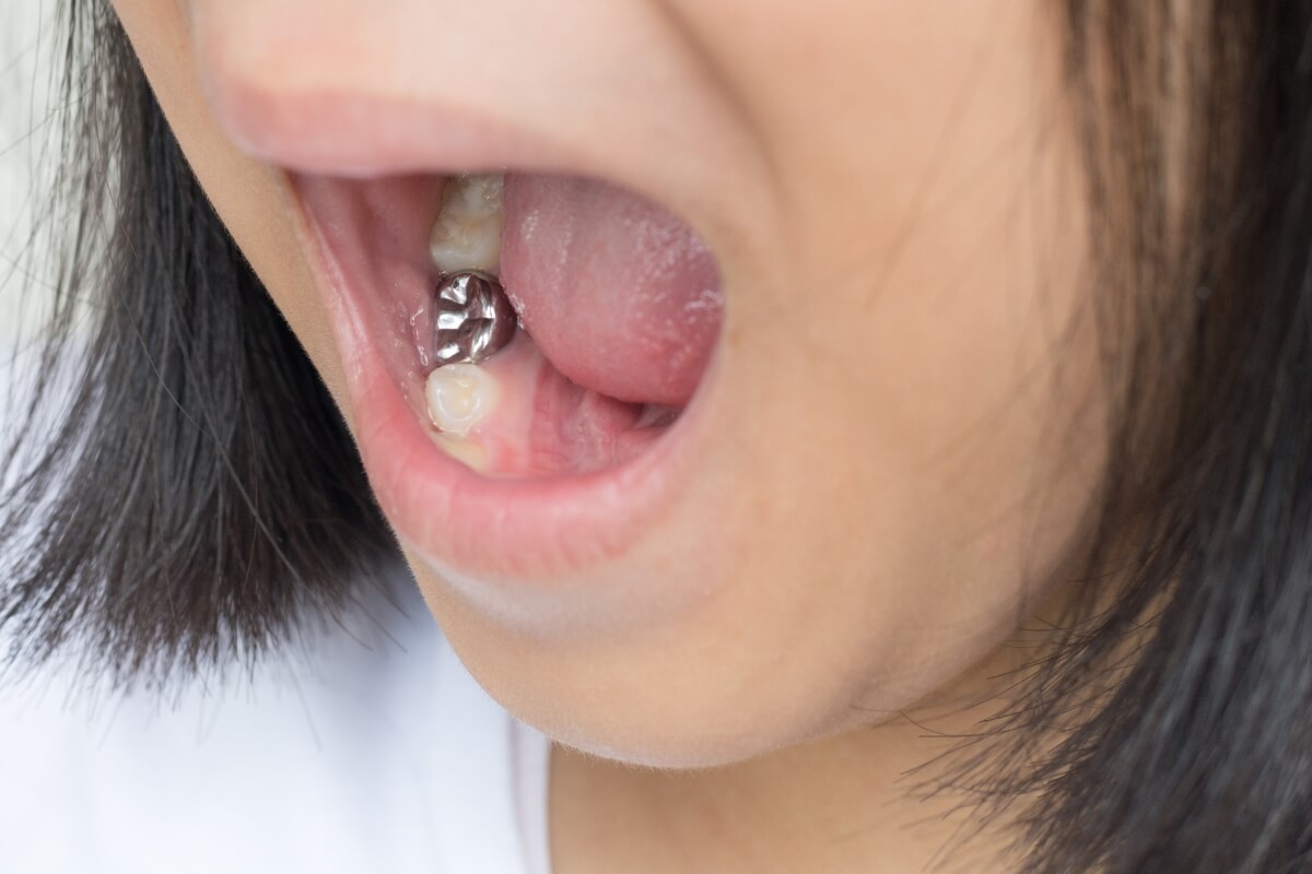 Silver-Filling-Teeth Silver Filling Teeth