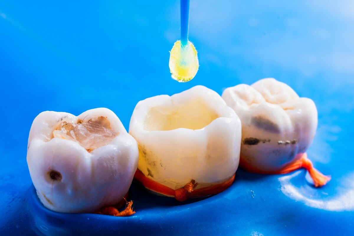 Tooth-Filling Tooth Filling