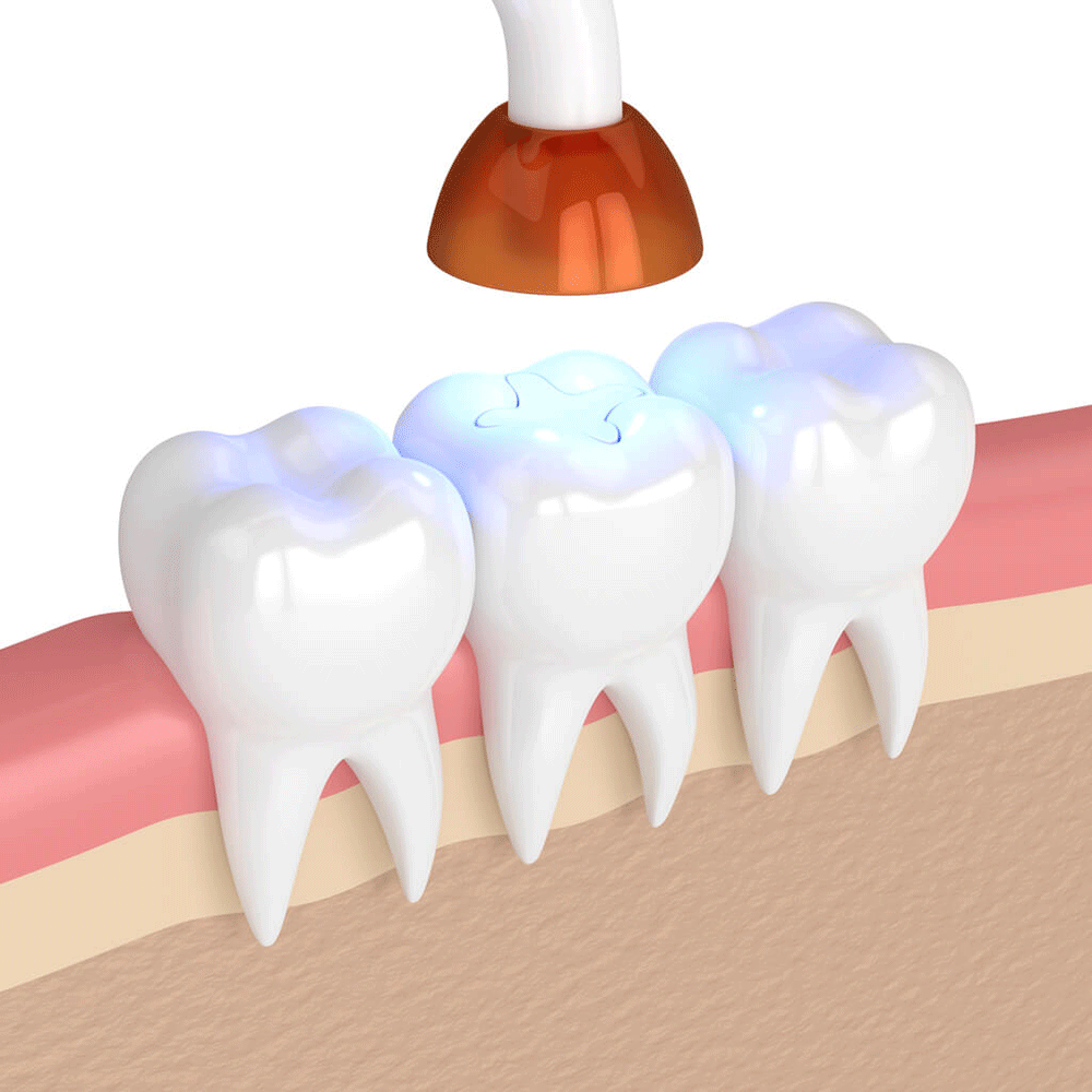 Cavity Fillings & Dental Sealants